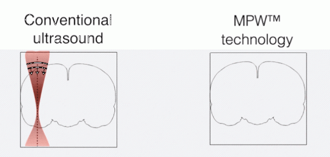 Gif showing the difference between conventional and plane wave ultrasound imaging