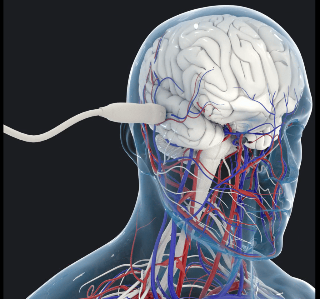 Transcranial imaging of the brain microvasculature in adults (artist’s impression). Courtesy A. Dizeux/M. Tanter.