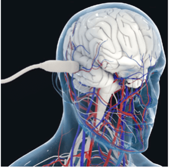 Improving diagnosis of stroke and aneurysm