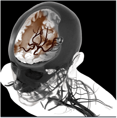 Detecting ischemia for improved treatment of traumatic brain injury and stroke