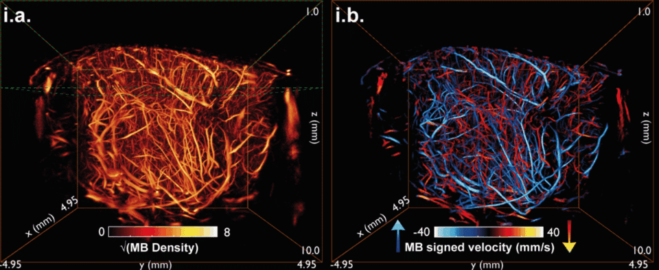 Unlocking the potential of true volumetric ULM angiography